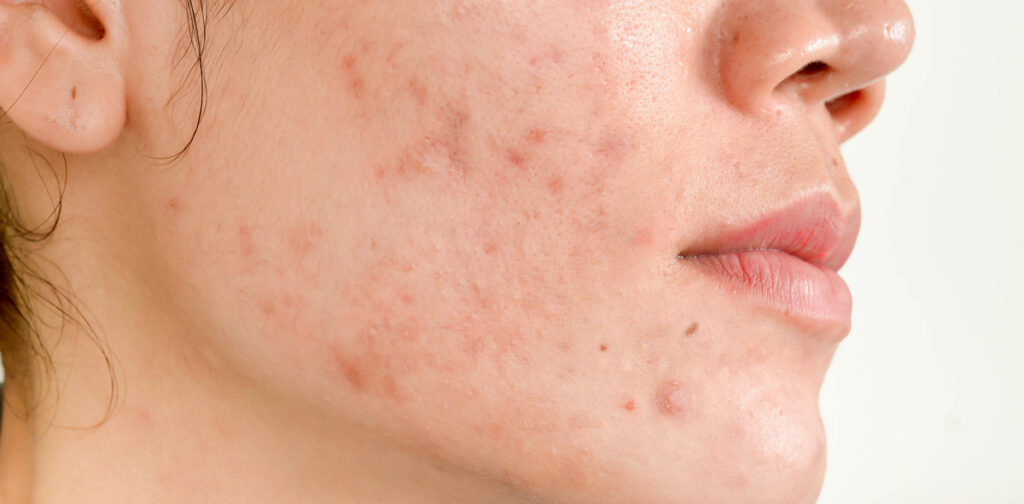 acne scars