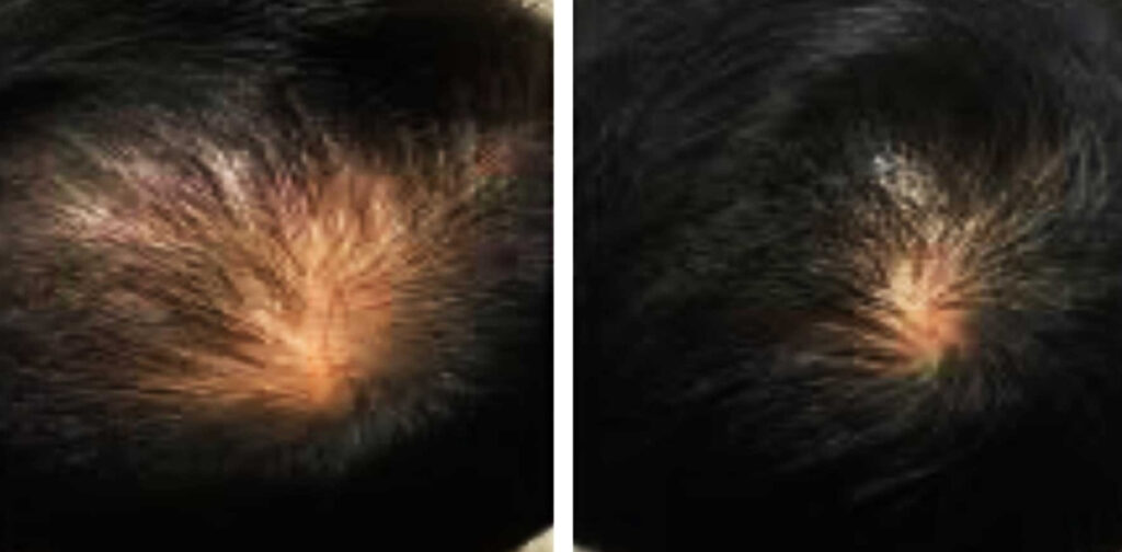 laser_hair_induction