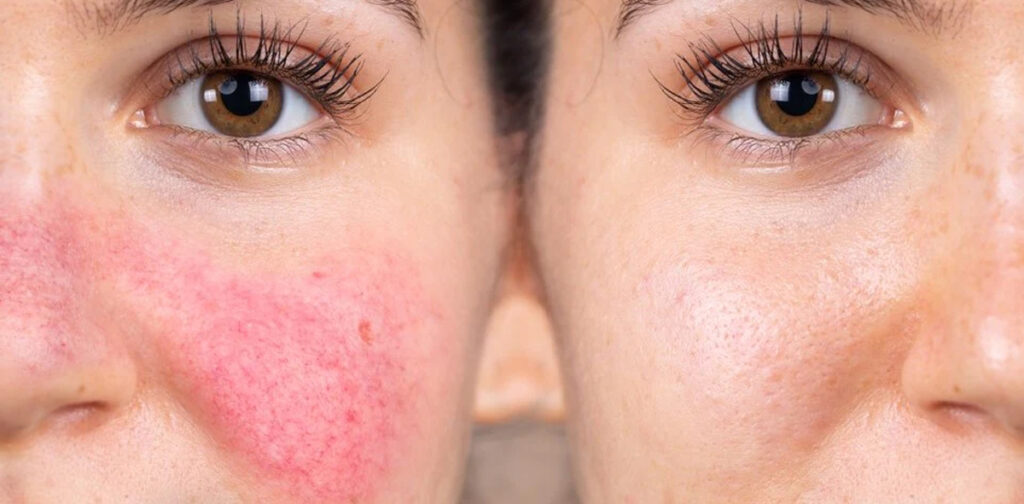 rosacea